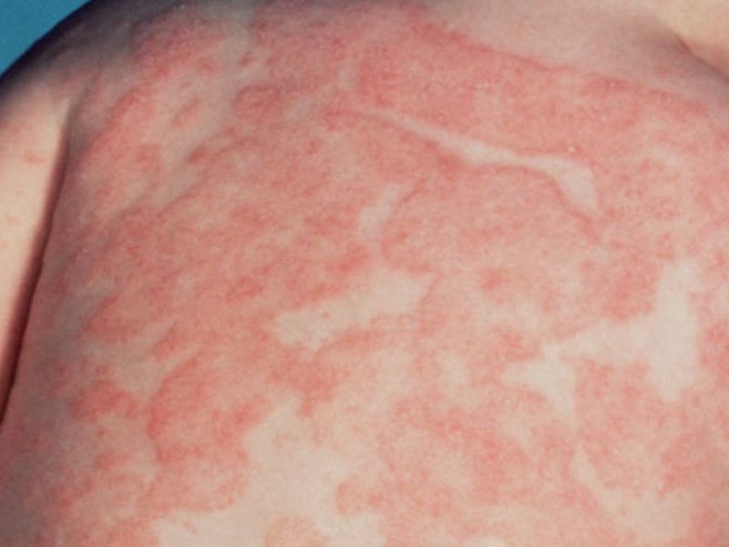 Как диагностируется аллергия