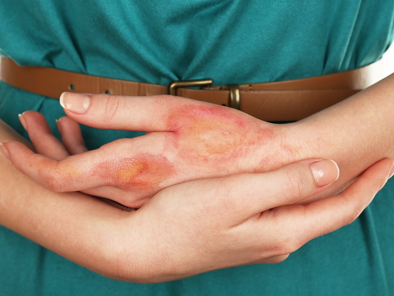 Описание видов дерматита кожных покровов