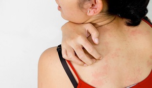Описание патологии кожи дерматита