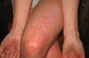 Высыпания на теле - основной симптом для всех видов дерматита