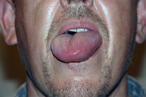 Самым опасным симптомом заболевания является поражение гортани и языка