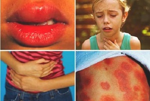 Чем опасна аллергия