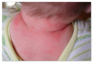 Из-за чего появляется аллергия у ребенка?