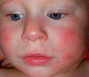 Эффективное лечение пищевой аллергии у ребенка