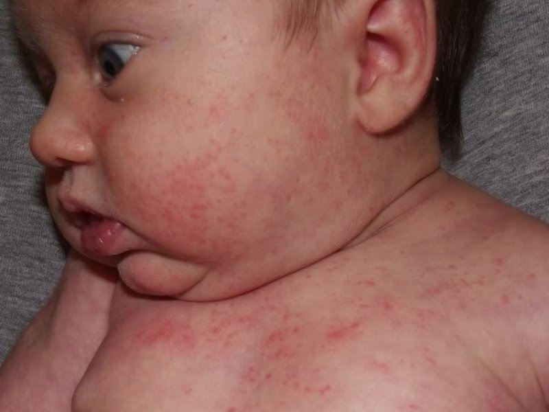 Симптомы аллергии у ребенка