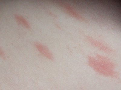 Как проявляется аллергия на коже, красные пятна и их лечение