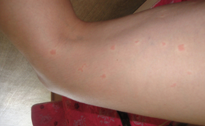 Как провяляется аллергия на коже