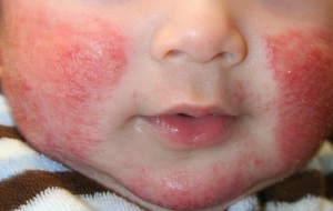 Описание симптомов атопического дерматита у детей